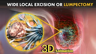 What is a Lumpectomy or Wide Local Excision How Lumpectomy surgery is Performed  Breast Cancer [upl. by Sral]