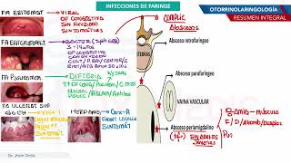 Otorrinolaringología  Infecciones de faringe [upl. by Kirschner]