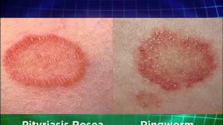 Ringworm Explained Medical Course [upl. by Kalina466]