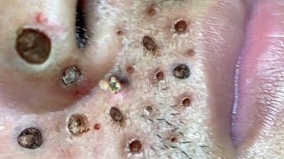 Blackhead Removal With Sac Dep Spa 1000405 [upl. by Osbourn245]