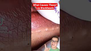 CRAZY BLACKHEAD REMOVAL AROUND LIPS shorts [upl. by Nosreh]