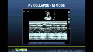 Ultrasound Podcast  PERICARDIAL TAMPONADE LEARN THIS KNOW THIS [upl. by Ylrrad321]