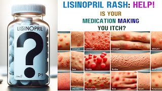 Lisinopril Rash Causes Symptoms and Relief [upl. by Benoit]