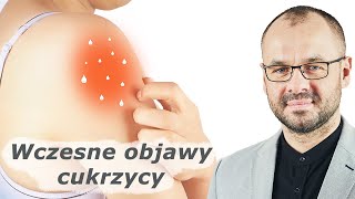 Nie ignoruj ​​tych 10 wczesnych objawów cukrzycy [upl. by Haldis]