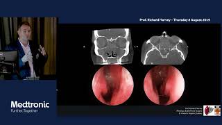 Understanding Inflammatory sinus disease nasal polyps and chronic sinusitis  Prof Richard Harvey [upl. by Ddene15]