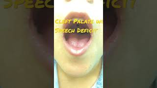 Cleft Palate with Speech Deficit [upl. by Erund]