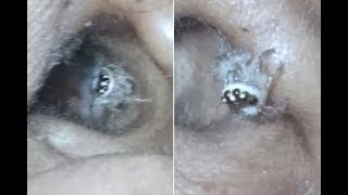 Horrified doctors find spider living INSIDE womans ear [upl. by Noled]