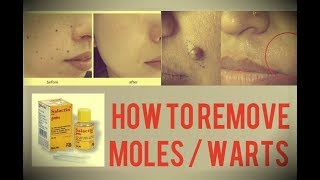 SALACTIN PAINT Usage  Salicylic Acid  Removal OF Moles amp Warts  2017 [upl. by Madora242]