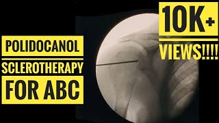 Polidocanol Sclerotherapy for Aneurysmal Bone Cyst [upl. by Terrena]