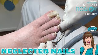 Neglected nails feet κεντροποδιου foot footcare podologos orthotics calluses podiatrist [upl. by Harbot]