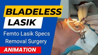 Bladeless LASIK  Femto Lasik Specs Removal Surgery  Bladeless Lasik Eye Surgery Animation [upl. by Hepsibah]