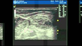 Ultrasound Guided ankle block part 1 [upl. by Ruiz]