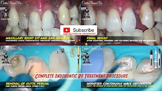 endodontic retreatment anterior teeth perawatan saluran akar not saraf gigi pop dentistry eighteeth [upl. by Elin453]