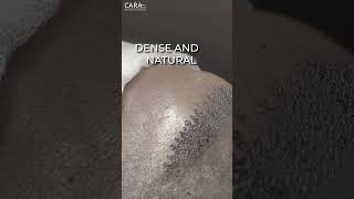 How Hair Transplant Works  Hair Transplant Timelapse [upl. by Aleydis243]