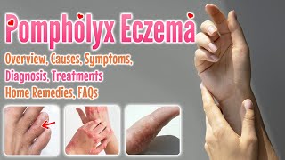 Pompholyx eczema causes symptoms diagnosis treatment home remedies FAQ  Dyshidrotic eczema [upl. by Ferdy186]