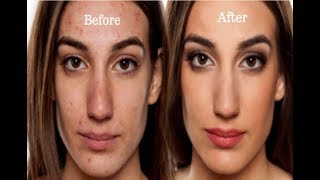 How to Get Rid Of Acne And Pimples With Raw Apple Cider Vinegar [upl. by Gabriellia]