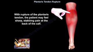 Plantaris Tendon Rupture  Everything You Need To Know  Dr Nabil Ebraheim [upl. by Ileana]