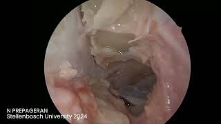 Module 4 Orbital Optic Nerve Decompression Intraconal Dissection [upl. by Nottnerb]