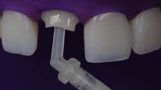 EN Fiberglass Posts and Core Buildups Cementation PROTOCOL [upl. by Dimmick398]