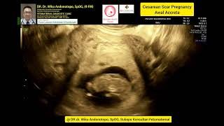 Awal Accreta Cesarean Scar Pregnancy 10 weeks [upl. by Ecirb]