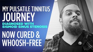 I cured my Pulsatile Tinnitus and now whooshfree diagnosed with Sigmoid Sinus Stenosis [upl. by Dickie]