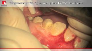 GINGIVECTOMY Fotona Lightwalker ErYAG Laser [upl. by Berkie]