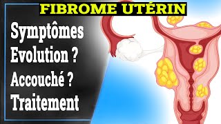 Fibrome Utérin Symptômes Causes Traitement  Gynécologie [upl. by Ahsikrats]