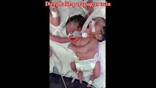 Neonatal Cases  Rare conjoined twins with two heads one body Dicephalic parapagus twin neonate [upl. by Arleen]