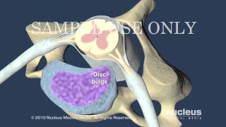 Cervical Disc Herniation [upl. by Amelina]