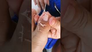 ang laki NG ingrown😱satisfyingvideos ingrownnailtoe raketerangnanay youtubevideoviral [upl. by Knute678]