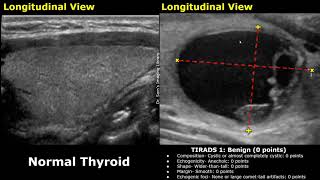 ACR TIRADS Classification Of Thyroid Nodules Ultrasound  Thyroid Imaging Reporting and Data System [upl. by Mcleroy]