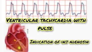 ventricular tachycardia with pulse [upl. by Rhodia]