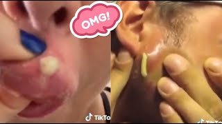 Satisfying Blackhead Removal Compilation  Best Techniques for Clear Skin [upl. by Yluj]