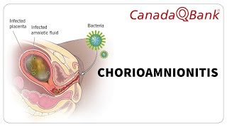 Chorioamnionitis [upl. by Trautman]