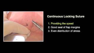 Key Suture Techniques  for Implant GBR Surgery [upl. by Aowda]