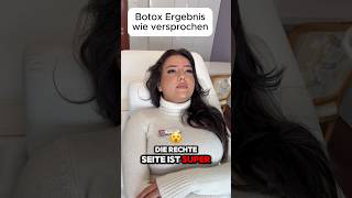 Botox Zornesfalte 5 Wochen danach aesthetix filler düsseldorf drgü doctor aesthetic botox [upl. by Jorgan]