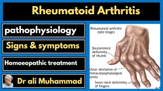 Rheumatoid Arthritis and homeopathy Dr Ali Muhammad [upl. by Gaspard107]