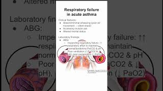 Respiratory failure in acute asthma [upl. by Narual]