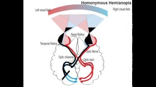 homonemous hemianopia [upl. by Addiego]