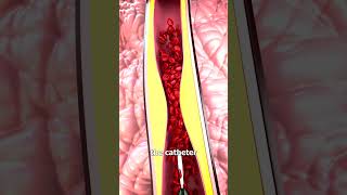 How Heart Stents Work 🤔 [upl. by Leatri]