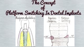 Platform Switching in Dental Implants Crestal Bone Loss around Dental Implants [upl. by Karyl]