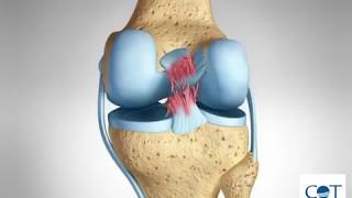 Lesión de ligamento cruzado posterior LCP [upl. by Borrell120]