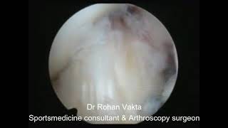 ACL Mucoid degeneration  Arthroscopic Debulking [upl. by Buskus867]