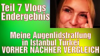 Augenlidstraffung Türkei Erfahrung Lidstraffung Vorhher Nachher Bilder Medical Exclusive Istanbul [upl. by Htebharas77]