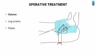 CORONOID FRACTURE  ORTHOPEDIC PG EXAM  CONCISE [upl. by Betthezul545]