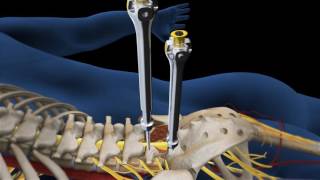 Lumbar Fusion of L5 S1 Animation [upl. by Drislane]