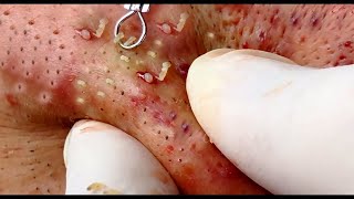 Pimple popping videos of 2021  Squeezing exploding acne Compilation [upl. by Kenna429]