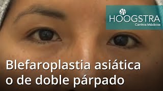 Blefaroplastia asiática o de doble párpado 19009 [upl. by Tut921]