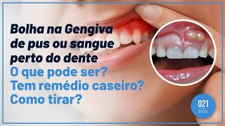 Bolha na Gengiva de pus ou sangue perto do dente O que pode ser Tem remédio caseiro Como tirar [upl. by Anoo]