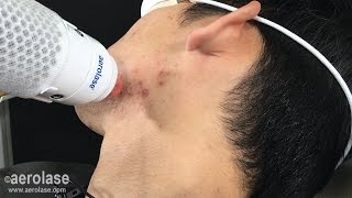 Testimonial amp Demo  NeoClear Acne Treatment on Asian Skin [upl. by Aleiram]